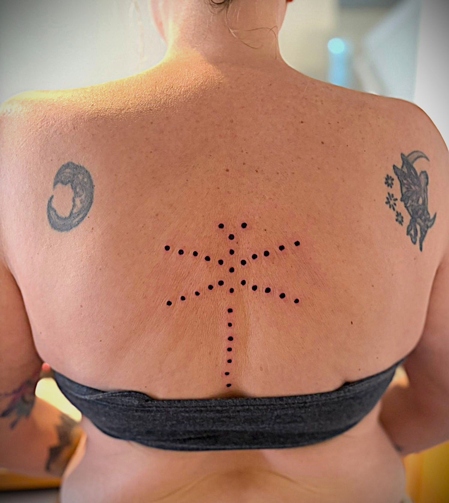 Thirty-three fresh kambo points along my thoracic spine, forming the shape of a dragonfly